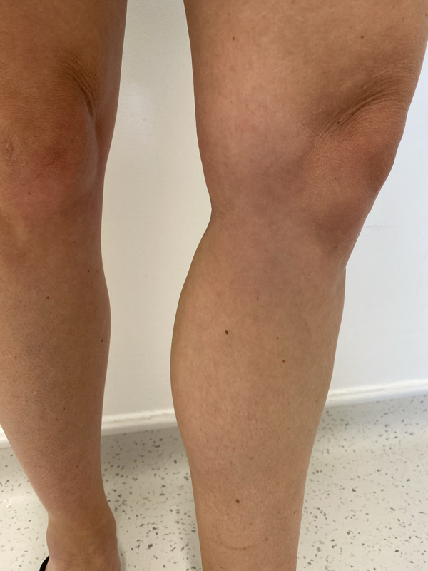Post-EVLA  and foam sclerotherapy